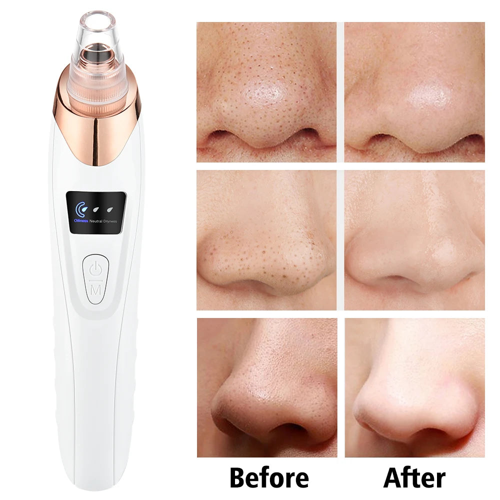 Electric Blackhead Remover Vacuum – Rechargeable Pore Cleaner