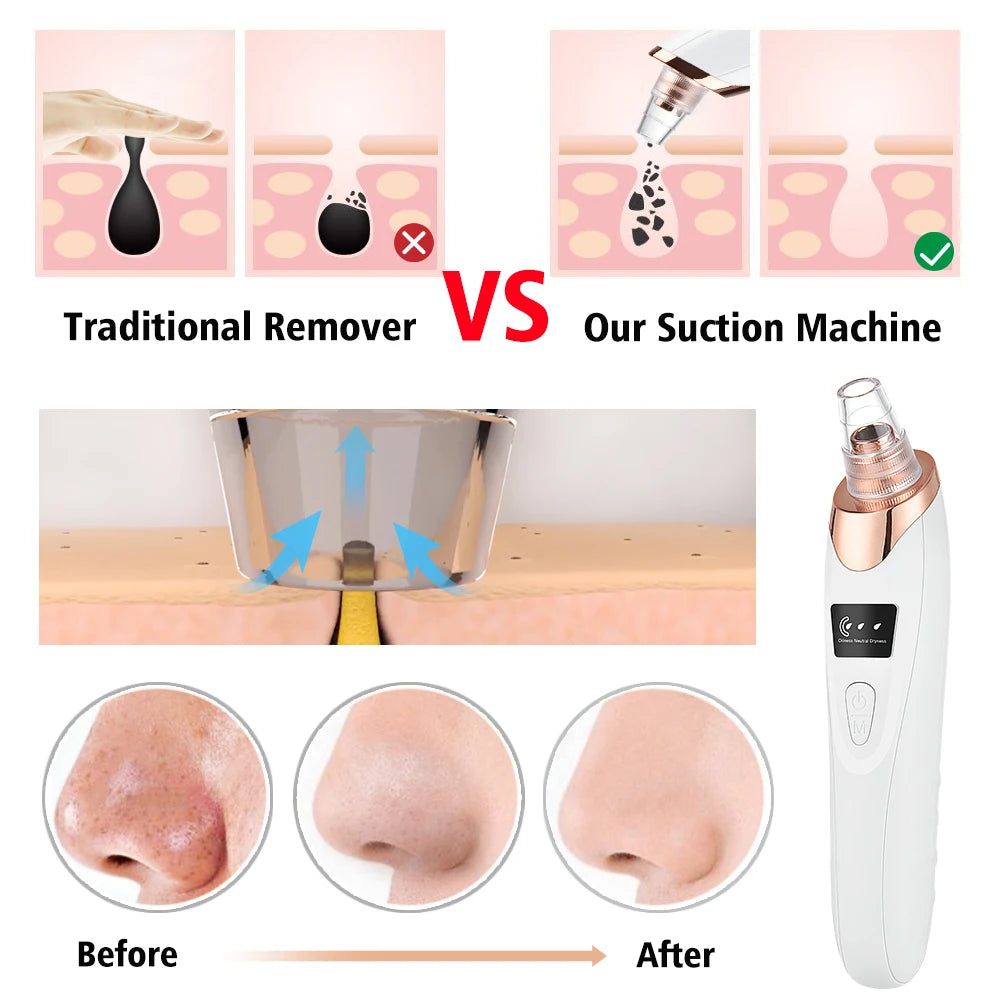 Electric Blackhead Remover Vacuum – Rechargeable Pore Cleaner
